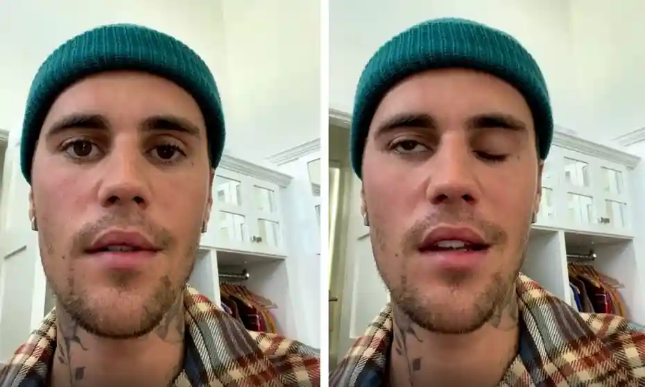 Justin beiber got affected by rare syndrome video getting viral