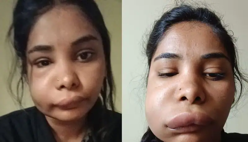 Kannada actress swathi sathish face got unrecognisable after root canal surgery