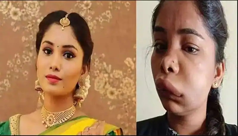 Kannada actress swathi sathish face got unrecognisable after root canal surgery